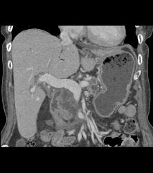 Pancreatic Adenocarcinoma - CTisus CT Scan