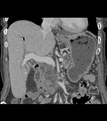 Pancreatic Adenocarcinoma - CTisus CT Scan