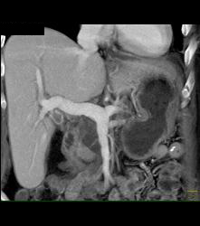 Cystic Tumor in Head of Pancreas - CTisus CT Scan