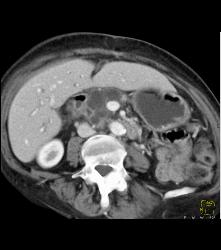 Cystic Tumor in Head of Pancreas - CTisus CT Scan