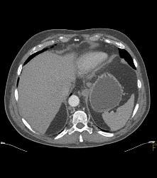 Subtle Pancreatic Cancer With Dilated Pancreatic Duct - CTisus CT Scan