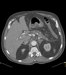 Subtle Pancreatic Cancer With Dilated Pancreatic Duct - CTisus CT Scan