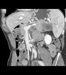 Carcinoma of the Tail of the Pancreas - CTisus CT Scan