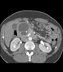 Pseudocyst in Head of Pancreas - CTisus CT Scan