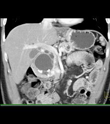 Pseudocyst in Head of Pancreas - CTisus CT Scan