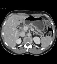 Chronic Pancreatitis - CTisus CT Scan