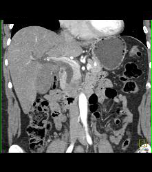 Ampullary Carcinoma - CTisus CT Scan