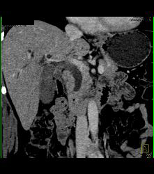 Ampullary Carcinoma - CTisus CT Scan