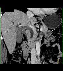 Ampullary Carcinoma - CTisus CT Scan