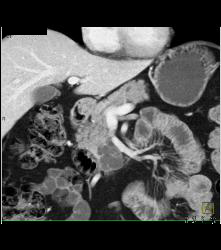 Intraductal Papillary Mucinous Neoplasm (IPMN) With Dysplastic Changes - CTisus CT Scan