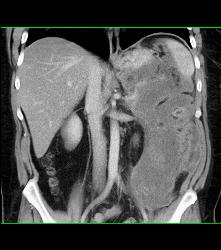 Pseudocyst With Splenic Vein Occlusion and Collaterals- See Sequence - CTisus CT Scan