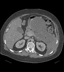 Pseudocyst With Splenic Vein Occlusion and Collaterals- See Sequence ...