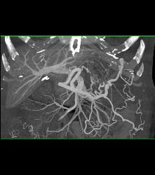 Pseudocyst With Splenic Vein Occlusion and Collaterals- See Sequence - CTisus CT Scan