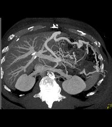 Pseudocyst With Splenic Vein Occlusion and Collaterals- See Sequence - CTisus CT Scan