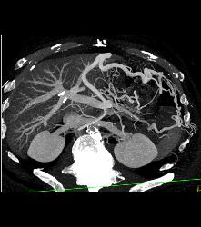 Pseudocyst With Splenic Vein Occlusion and Collaterals- See Sequence - CTisus CT Scan