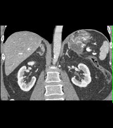 Pseudocyst With Splenic Vein Occlusion and Collaterals- See Sequence - CTisus CT Scan