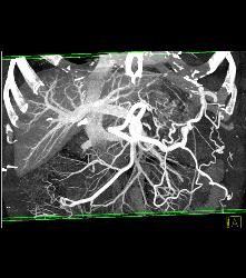 Pseudocyst With Splenic Vein Occlusion and Collaterals- See Sequence - CTisus CT Scan