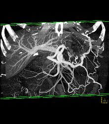 Pseudocyst With Splenic Vein Occlusion and Collaterals- See Sequence - CTisus CT Scan