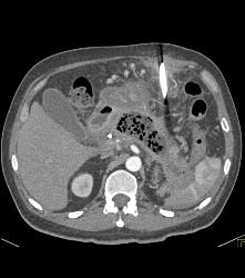 Pancreatic Abscess and Necrosis - CTisus CT Scan