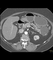 Serous Cystadenoma - CTisus CT Scan