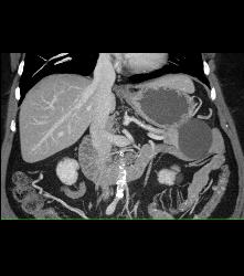 Serous Cystadenoma - CTisus CT Scan