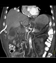 Post Whipple With Portal Vein Air, Gastric Emphysema and Ascites. Surgery Showed Leak and Anastomosis - CTisus CT Scan