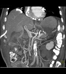 Post Whipple With Portal Vein Air, Gastric Emphysema and Ascites. Surgery Showed Leak and Anastomosis - CTisus CT Scan