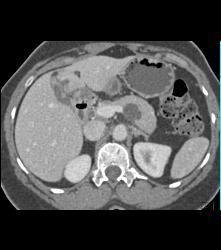 Intraductal Papillary Mucinous Neoplasm (IPMN) - CTisus CT Scan