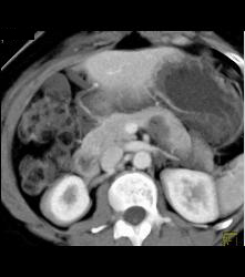 Intraductal Papillary Mucinous Neoplasm (IPMN) - CTisus CT Scan