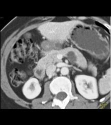 Intraductal Papillary Mucinous Neoplasm (IPMN) - CTisus CT Scan