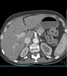 Multiple Intraductal Papillary Mucinous Neoplasms (IPMNs) - CTisus CT Scan