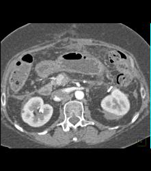 Post Whipple Changes - CTisus CT Scan