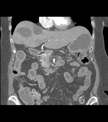 Post Whipple Changes - CTisus CT Scan