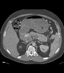 Islet Cell Tumor in Tail of the Pancreas - CTisus CT Scan