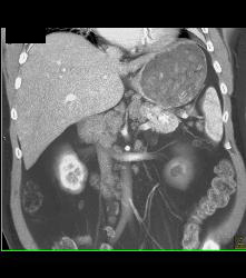 Islet Cell Tumor in Tail of the Pancreas - CTisus CT Scan