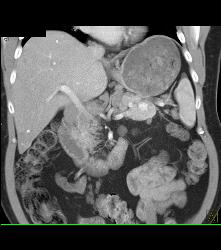 Islet Cell Tumor in Tail of the Pancreas - CTisus CT Scan