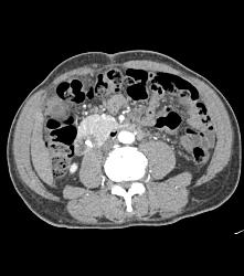 Prominent Head of Pancreas - CTisus CT Scan