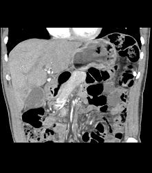 Prominent Head of Pancreas - CTisus CT Scan