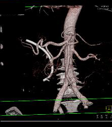 Prominent Head of Pancreas - CTisus CT Scan