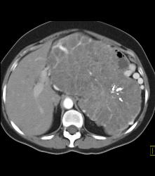 Serous Cystadenoma- Invasive - CTisus CT Scan