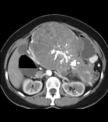 Serous Cystadenoma- Invasive - CTisus CT Scan