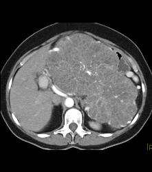 Serous Cystadenoma- Invasive - CTisus CT Scan