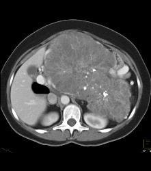 Serous Cystadenoma- Invasive - CTisus CT Scan