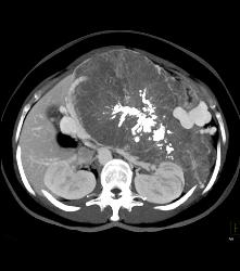 Serous Cystadenoma- Invasive - CTisus CT Scan