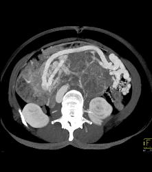 Serous Cystadenoma- Invasive - CTisus CT Scan