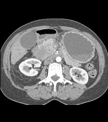 Pancreatic Lymphoma - CTisus CT Scan