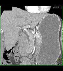 Pancreatic Lymphoma - CTisus CT Scan