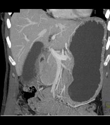 Pancreatic Lymphoma - CTisus CT Scan