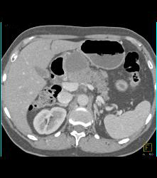 Adenocarcinoma of the Pancreas With Venous Invasion - CTisus CT Scan