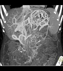 Adenocarcinoma of the Pancreas With Venous Invasion - CTisus CT Scan